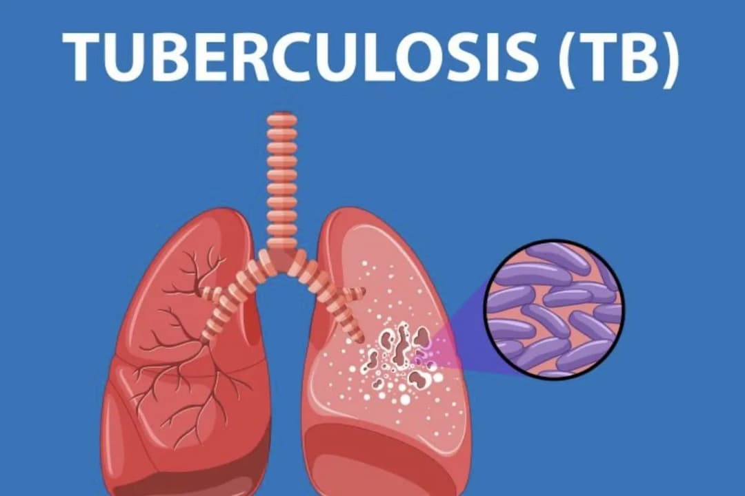 Klinik Simpang Pemda - Pelayanan Hebat Pengobatan Tepat - Klinik Terbaik di Kota Medan - WHO Tetapkan Tuberkulosis Sebagai Penyakit Menular Paling Mematikan Dr.Bram Sembiring : Jangan Takut untuk Berobat Tuberkulosis Bisa Sembuh